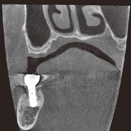 図10d CBCT前頭断。