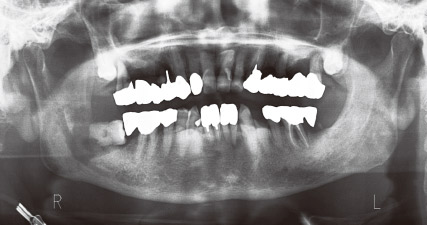 図12 初診時パノラマX線写真。