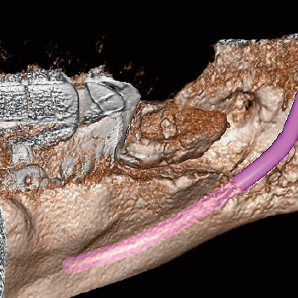 図13c 初診時ボリュームレンダリング。下顎管を描画することで腫瘍の進展度をより明確にさせることができる。