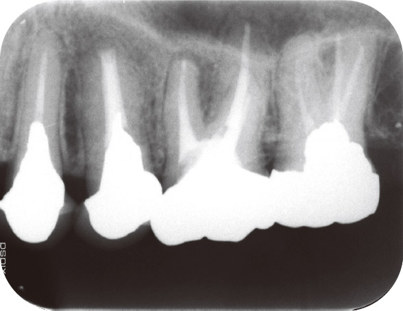 図2 2015年8月。メンテナンス時のデンタルX線写真。