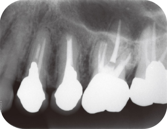 図5 2016年3月。違和感が消失し、根管充填時のデンタルX線写真。