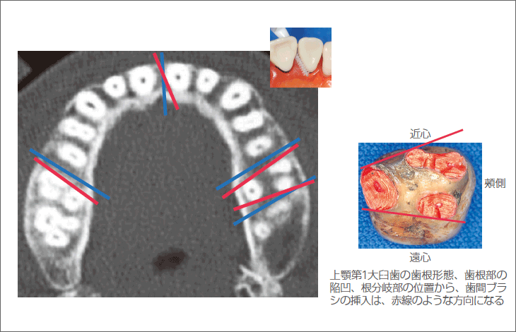 図6 上顎歯頸部の歯根形態と歯間ブラシの挿入方向