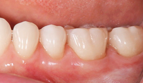 図10 隣接面歯頸部のカントゥア、コンタクトポイントなど理想的に回復できた。