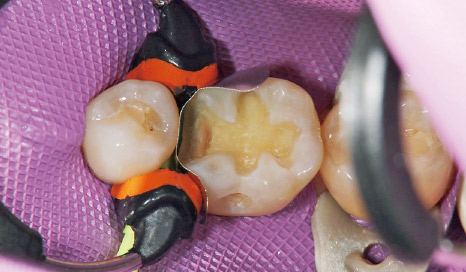 図3 通法に従いラバーダム防湿下、修復歯にウェッジとスリックバンド、3Dリテーナーを設置。本症例のように近心頰側隅角近くまで窩洞がある場合、先端ゴム部分を調整して窩縁にフィットさせる。