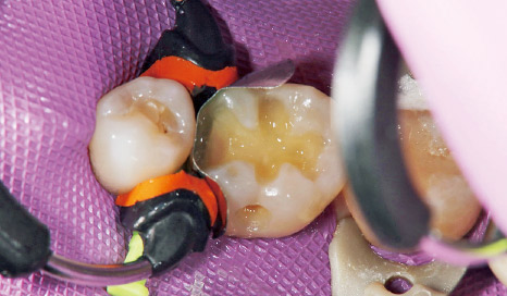 図4 クリアフィルマジェスティESフローHighにて窩底、歯頸側窩縁部などにライニング。