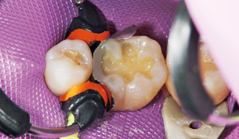 図6 解剖学的象牙質部分にクリアフィルマジェスティES-2 Premium A3デンティンペーストを充填。
