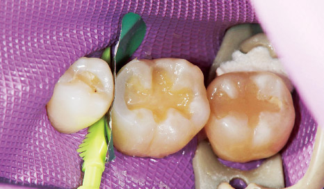 図7 隣接面部の充填が完了したところでスリックバンドを除去し、充填部歯肉側を光重合。以降はこのまま咬合面形態を作っていく。
