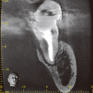 #37のCBCT冠状断面像