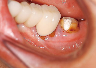 #37近心歯頸部の瘻孔の写真