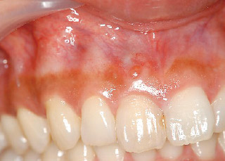 #11付近の歯肉に見られる瘻孔の写真