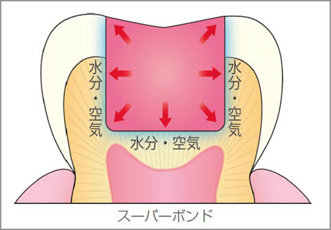 図3 スーパーボンドは窩壁から重合が進み、コントラクションギャップが生じにくい。