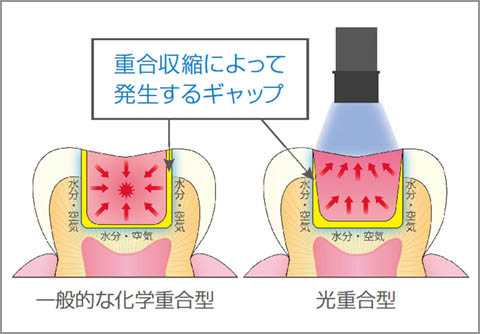 図4 一般的な化学重合型レジンや光重合型レジンでは、コントラクションギャップが生じやすい。