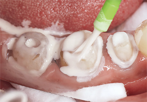 図21 支台歯にも混和泥を塗布する。