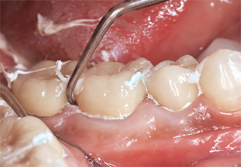 図22 補綴物を素早く支台歯に圧接し、スケーラーや探針などで余剰セメントを除去していく。