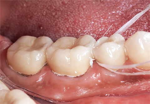 図23 コンタクトと歯間乳頭部は余剰セメントをフロスに巻き付け除去する。