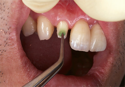 図12 へジルコニアクラウンを装着する。表面処理材グリーンで支台歯に歯面処理を行う。