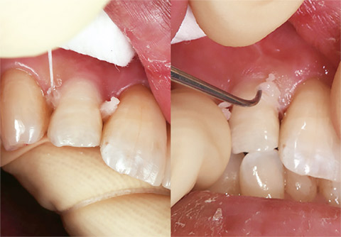 図15 フロス、スケーラーや探針にて余剰セメントを除去。余剰セメントが硬化するまでに除去を完了する。