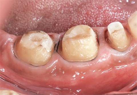 図18 下顎臼歯に連結冠を装着する。