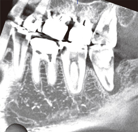 #36・38歯根病変の歯列平行断像で明るすぎる。
