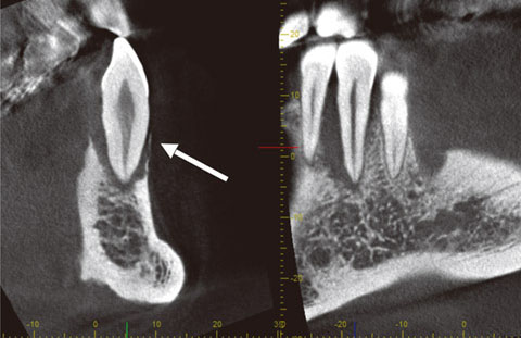 図11 適正なコントラスト画像では、#33根側病変と薄い頰側壁が良く描出されている。
