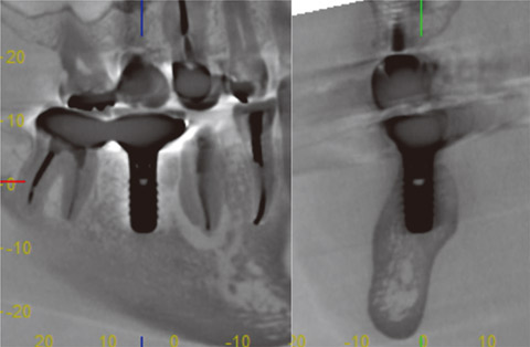 図15 図14の反転像では、インプラント体周囲のアーチファクトが軽減されて周囲骨が見えてきた。