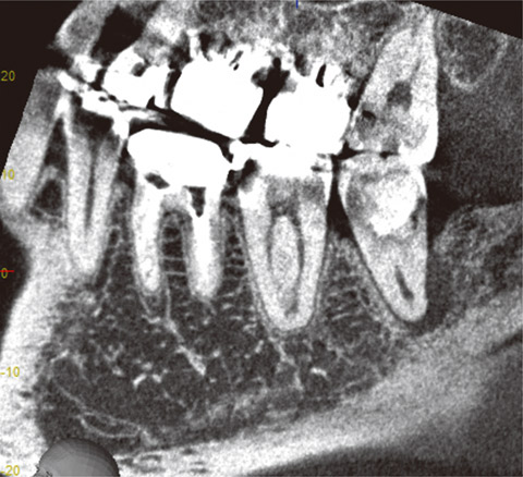 図16 最も薄い断面厚0.125mmの歯列平行断像。ノイズが相対的に増加して見にくい画像になるので、一般的には適していない。