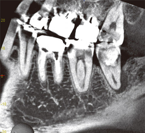 図17 断面厚0.5mmにすると、ノイズが減少してより観察しやすい画像となる。歯根の観察に向いている。
