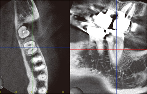 図20 #37の根管を表示しようとしたが、横断像（左側）において断面の方向（直行した2直線）は歯根断面で斜め方向になっており、歯列平行断像（右側）では根管はうまく表示できていない。