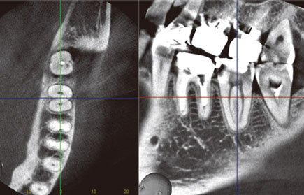 図21 断面方向を歯根断面にそれぞれ垂直方向に調整すると（左側）、根管が鮮明に表示できた（右側）。