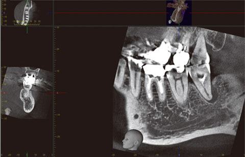 図22 PC画面上の4画像の中で、右下の歯列平行断像のみを大きく拡大した場合。