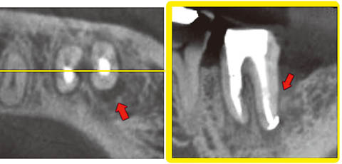 図10 根管治療開始後4ヵ月のCBCT画像。遠心隅角部に歯周疾患に起因する垂直性の骨欠損が残っている