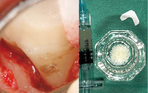 図11 遠心隅角部には縁下歯石をみとめ、歯周組織再生誘導材料と他家骨、吸収性コラーゲン膜を用いた歯周組織再生療法を行った。