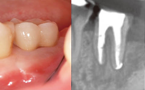 図12 最終補綴処置時。透過像の改善、骨の平坦化が獲得できた。