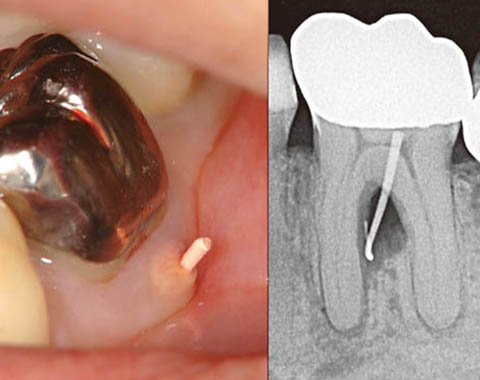 図2 頰側分岐部の透過像。デンタルでは一見生活歯に見え、歯周疾患由来型と間違えやすい。