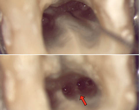 図3 上段：近心の中央にあるMiddle Mesial根管。下段: MM根管拡大終了後。