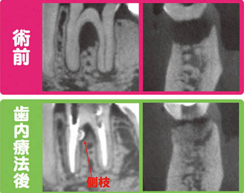 図4 術後のCT画像では分岐部透過像は改善し、原因はMM根管の側枝であることが分かる。