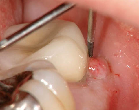 図6 初診時頰側中央〜遠心にかけて6〜8mmの深い歯周ポケットをみとめた。