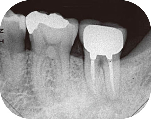 図7 初診時デンタルX線写真。失活歯であり、歯根破折あるいは歯内−歯周複合病変の可能性が考えられた。