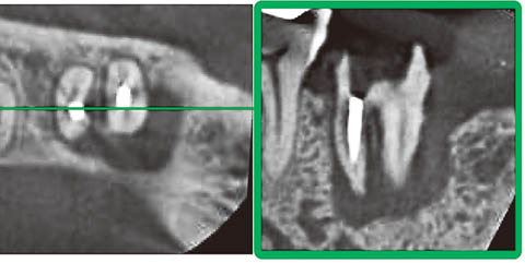 図8 メタルコア除去後のCBCT画像。デンタルX線写真では判断できない病変の拡がりを3次元的に確認できる。