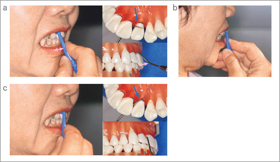 図12 上顎の歯間ブラシの挿入方向と把持法