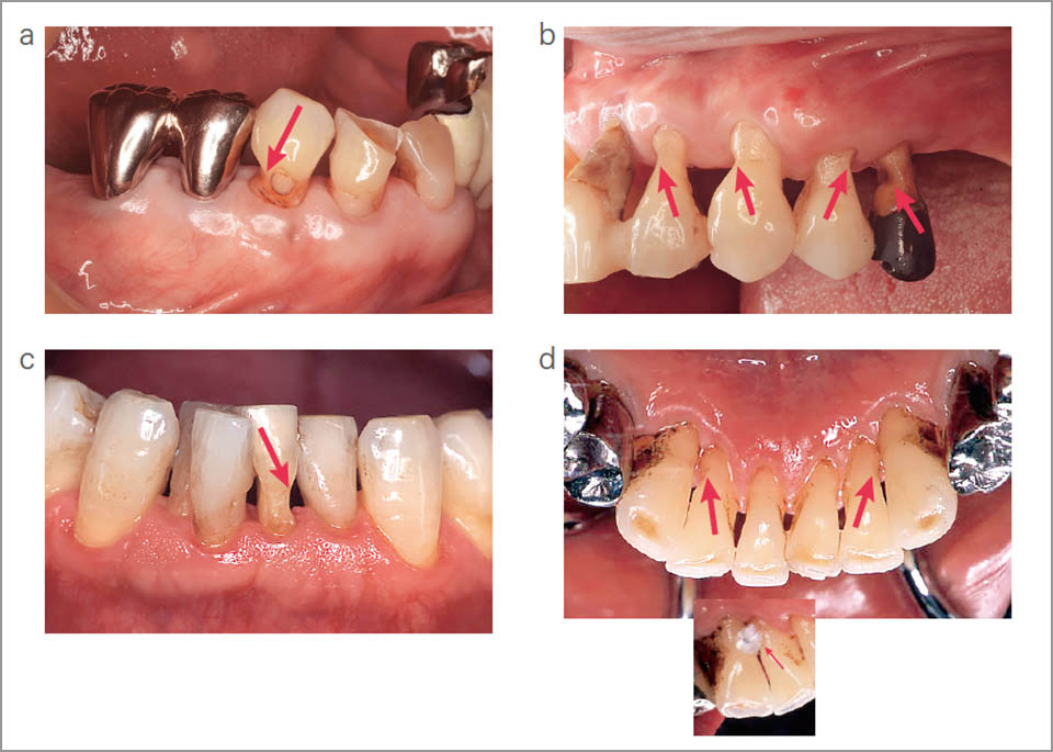 図15 歯間ブラシの誤用による歯頸部歯質欠損例（赤矢印）