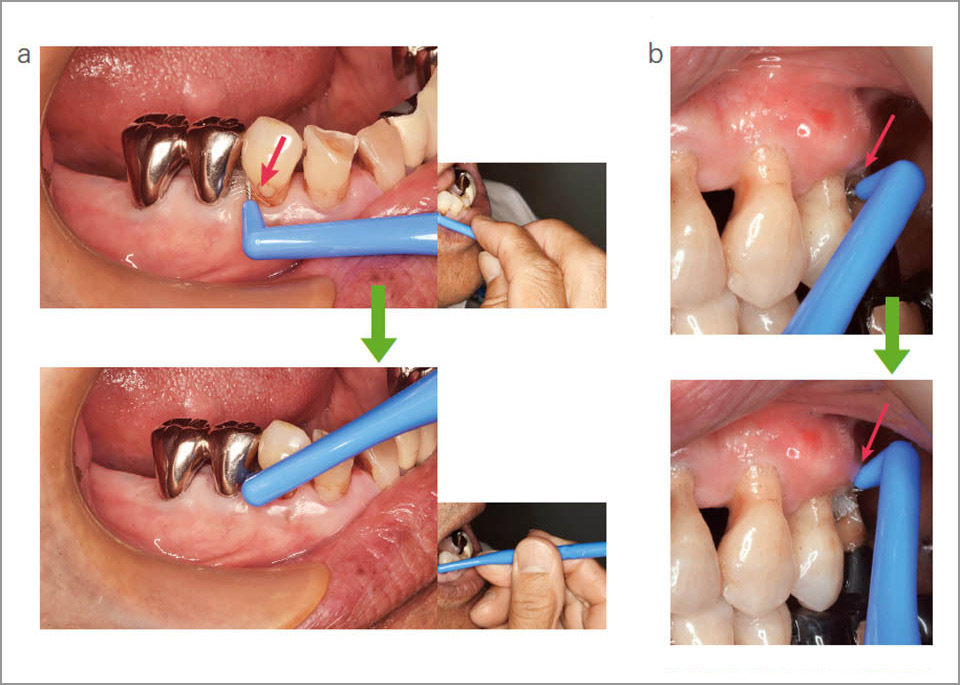 図16 歯間ブラシの誤用に対する対応
