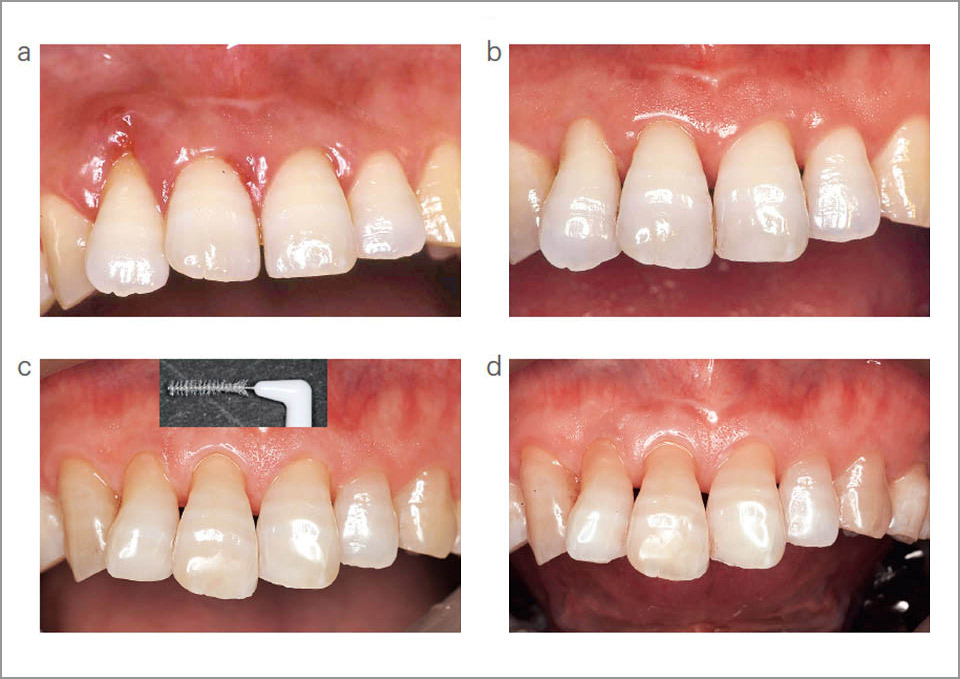 図18 歯間ブラシ定着長期症例　45歳男性