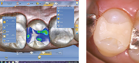 設計済み画面（左）と口腔内で試適されたMODインレー（右）