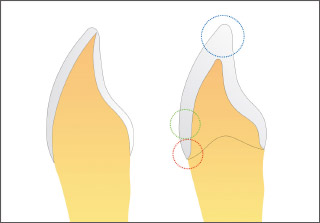 左:天然歯 右:FZCの断面イメージ図