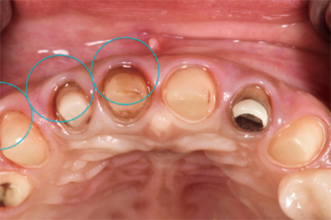 図22 歯周組織の咬合面観。歯頸部歯肉の厚みの左右差に注目して頂きたい。