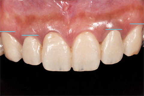 図13 1st Provisional Restoration。6前歯の歯頸線の位置が左右非対称である
