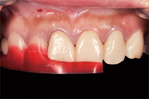 図14 Diagnosis Wax Up より作製したSurgical Templateを装着