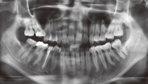 モリタ】歯科用CBCT 導入の経緯と根管治療での有用性｜デンタル