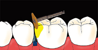 ウェッジを挿入すると、歯間が離開し、研磨スペースが生じる